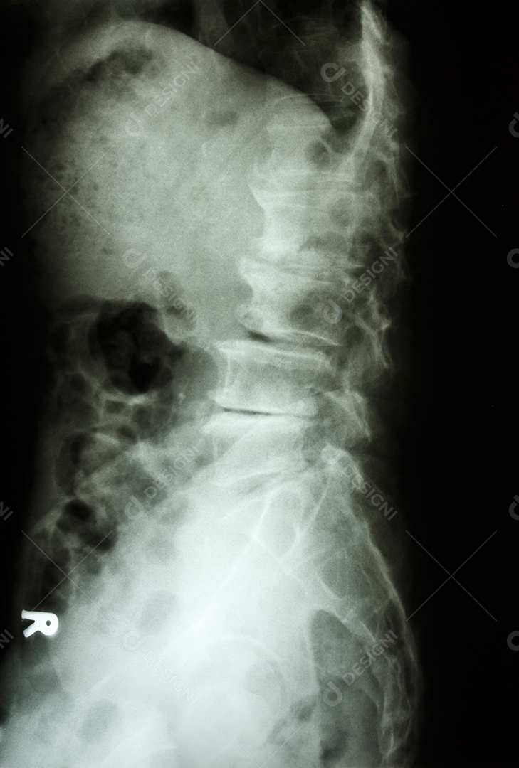 Radiografia de espondilolistese da coluna lateral