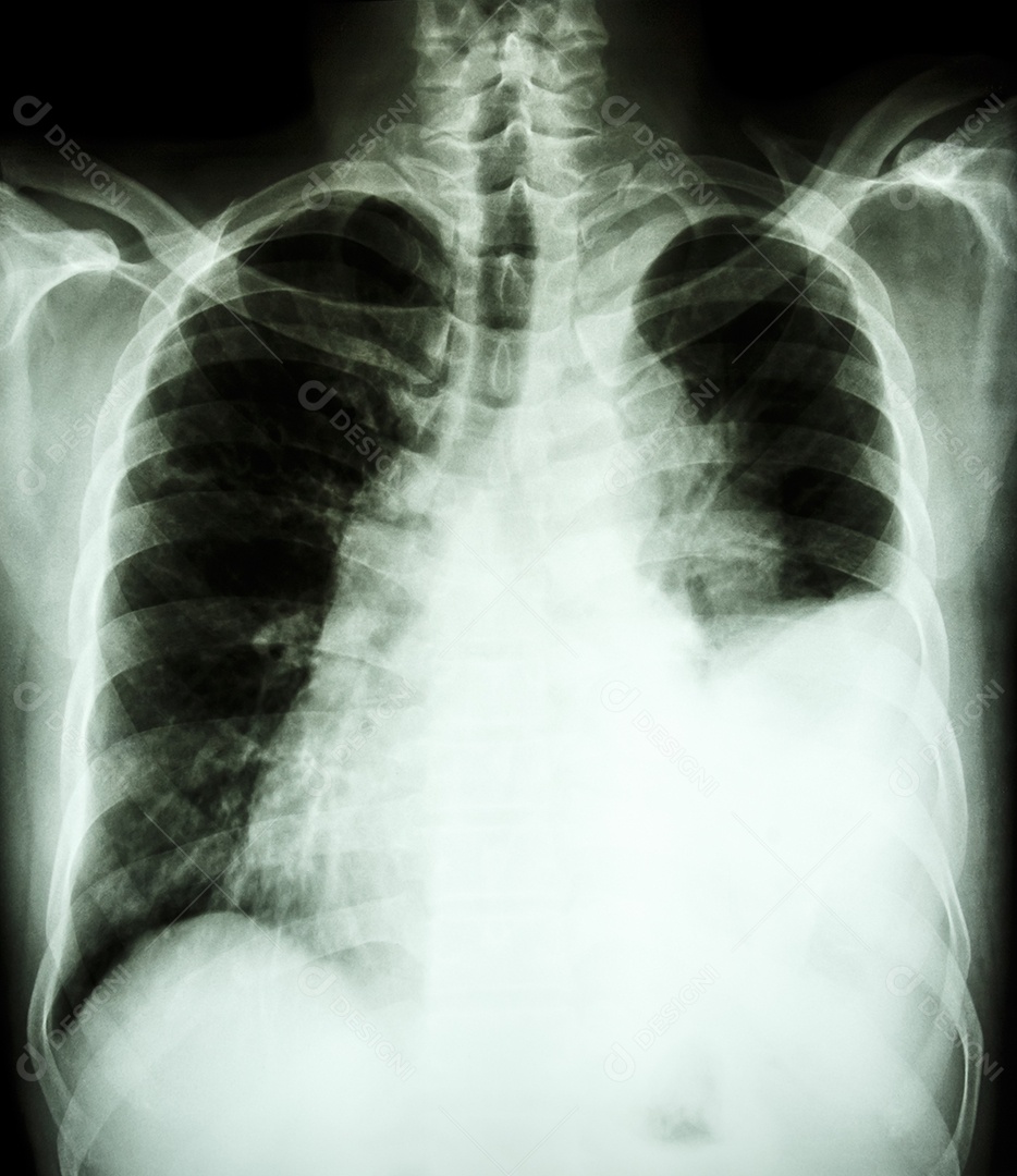 Radiografia do toráx mostra derrame pleural no pulmão esquerdo devido a câncer