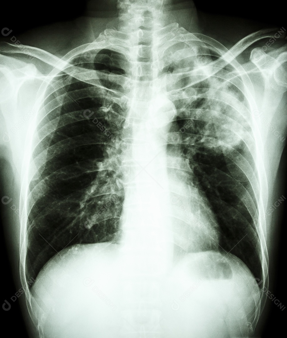 Infecção por Mycobacterium tuberculosis tuberculose pulmonar