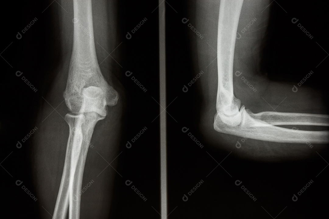 Cotovelo humano normal