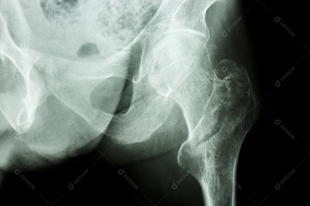 Fratura intertrocantérica do fêmur esquerdo