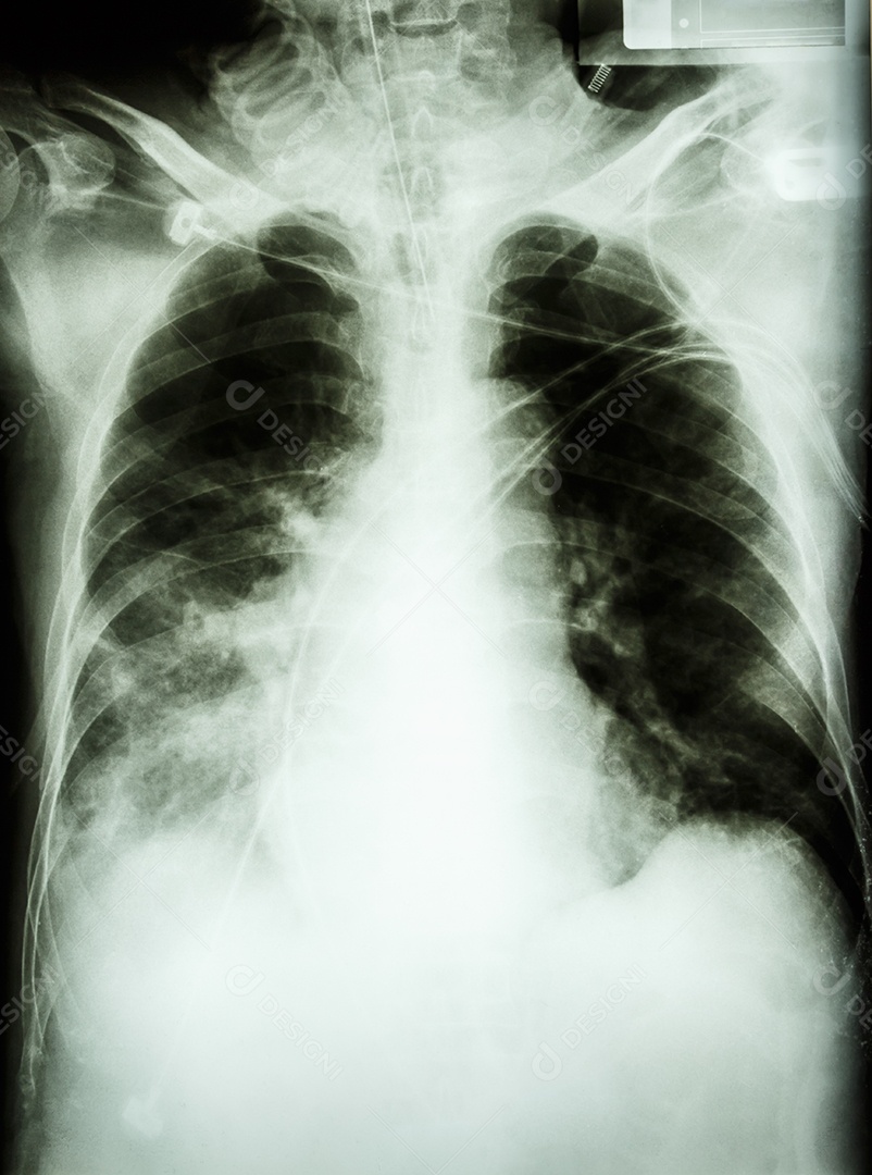 Pneumonia com insuficiência respiratória