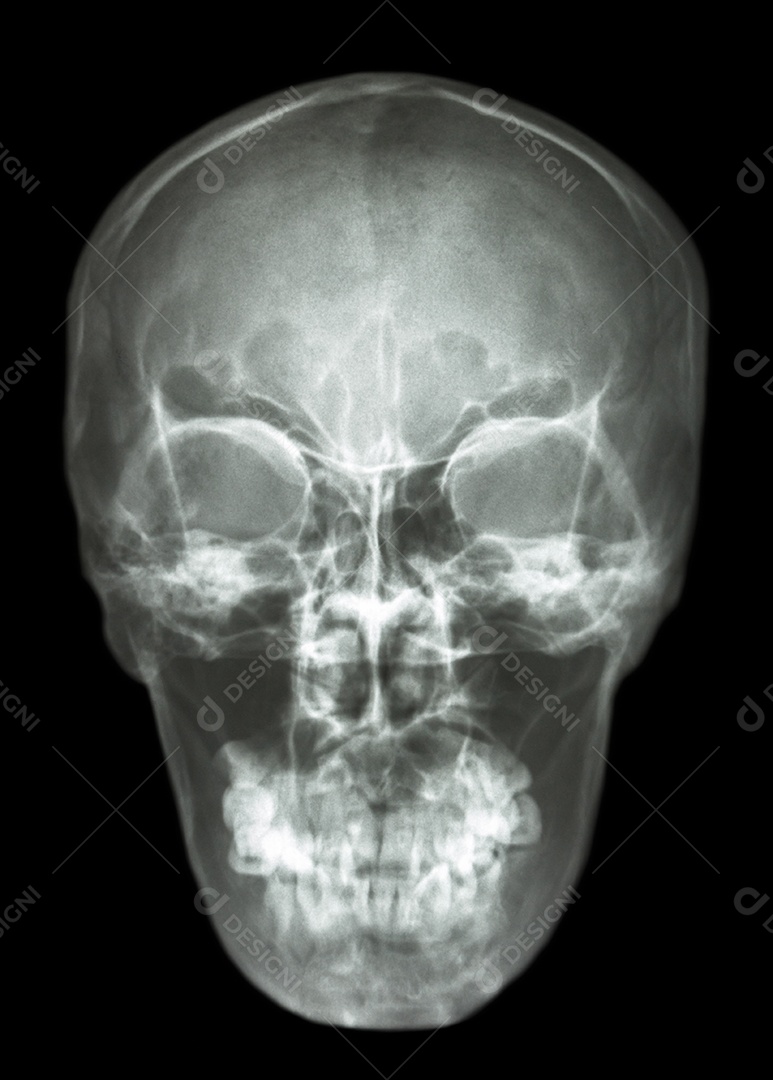 Raio x crânio humano asiático normal