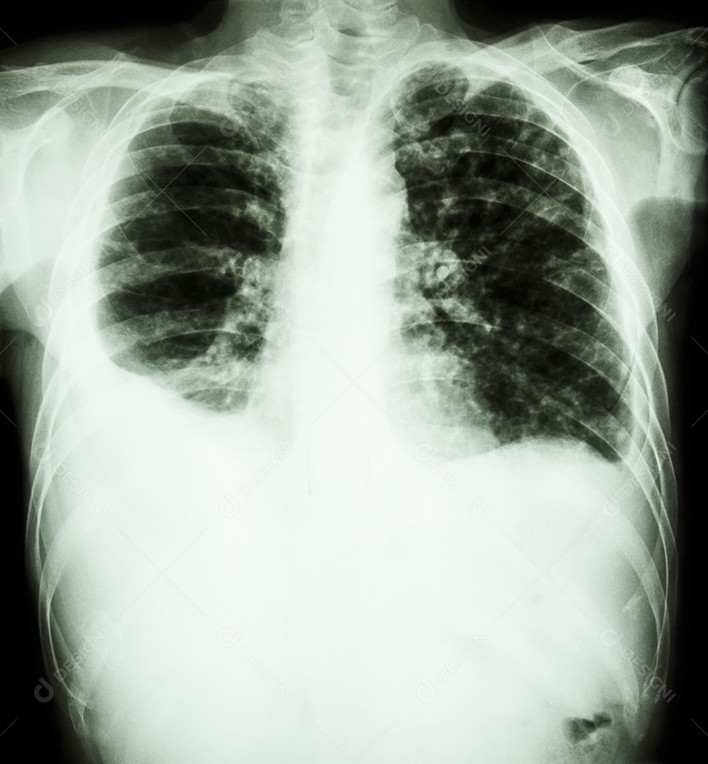 Derrame pleural direito e pleural esquerdo mínimo devido infecção