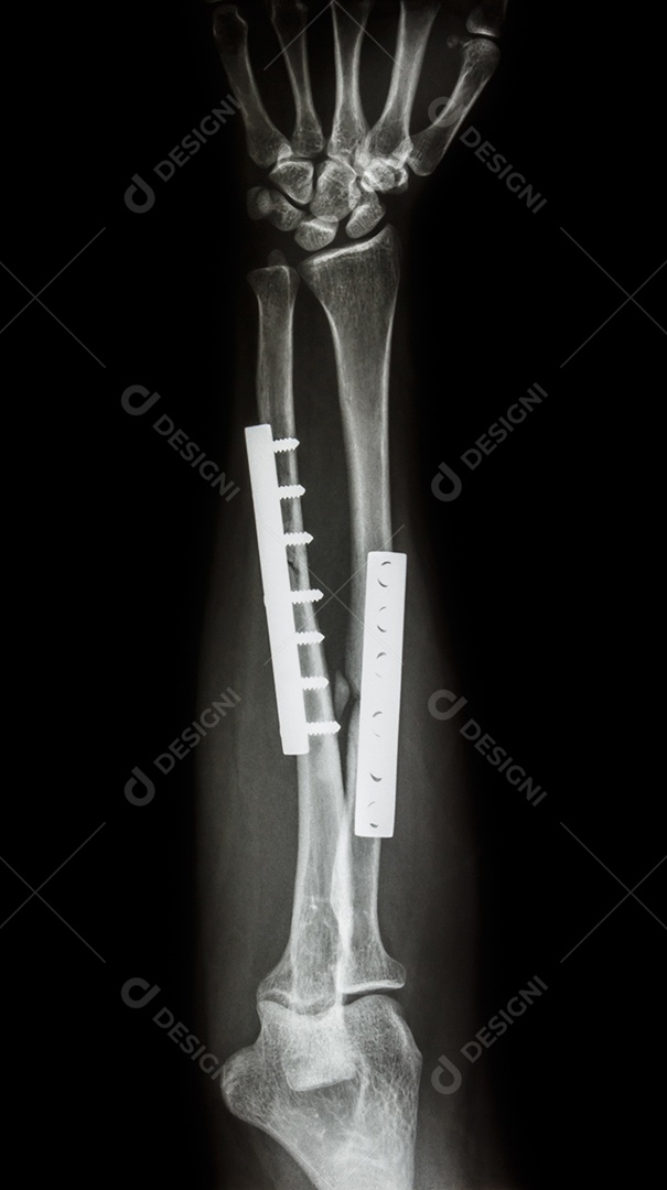 Diáfise de fratura do rádio e osso ulnar era operado e fixado internamente por placa e parafuso