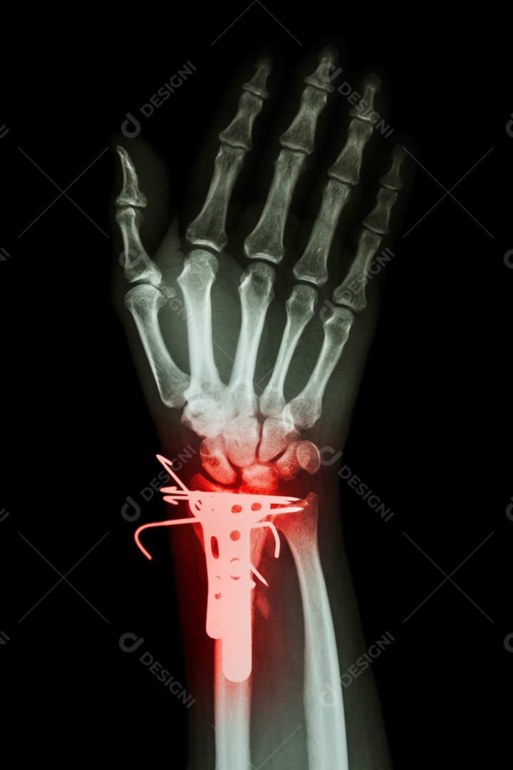 Radiografia de punho mostra fratura do rádio distal osso do antebraço