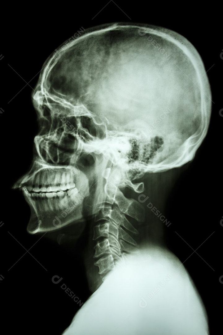 Raio X de crânio asiático e área em branco no lado esquerdo