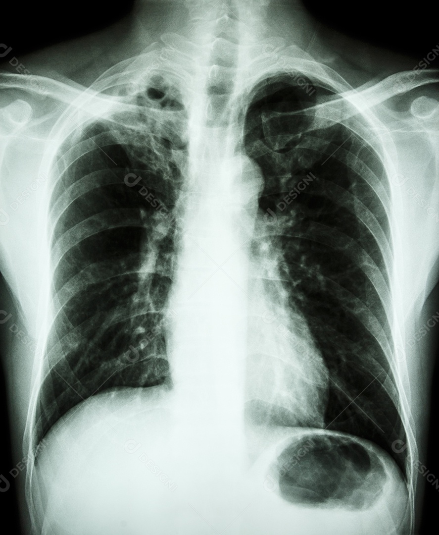 Tuberculose Pulmonar infiltração de cavidade e intersticial no pulmão