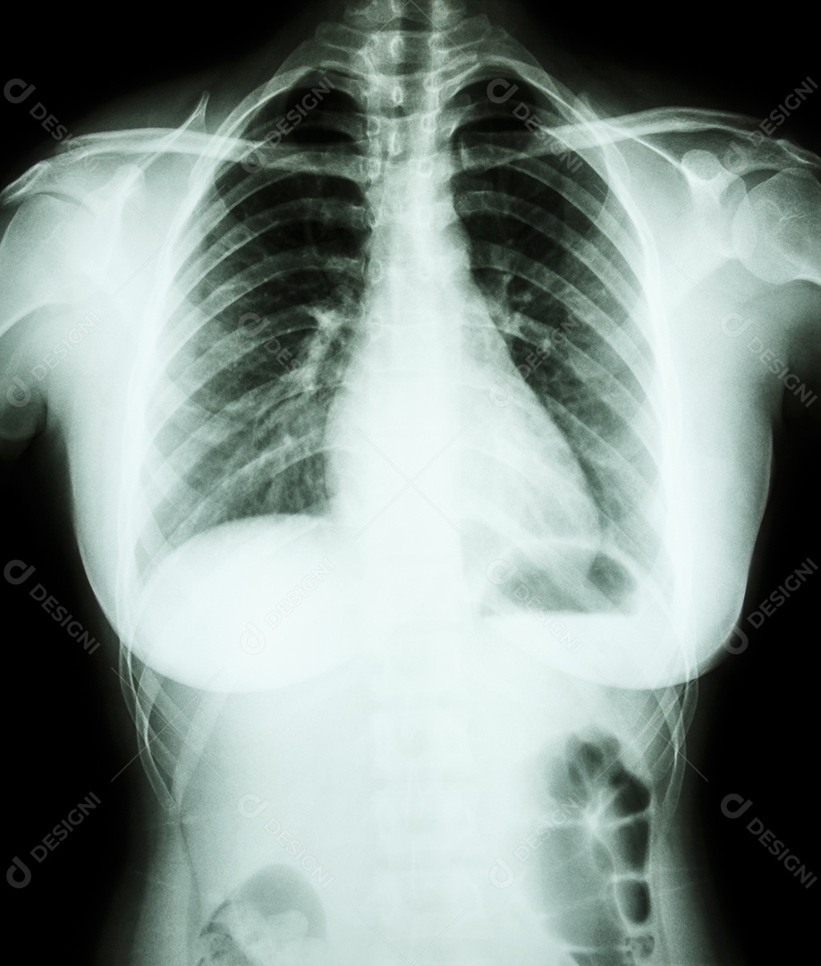 Raio x do tórax de uma mulher