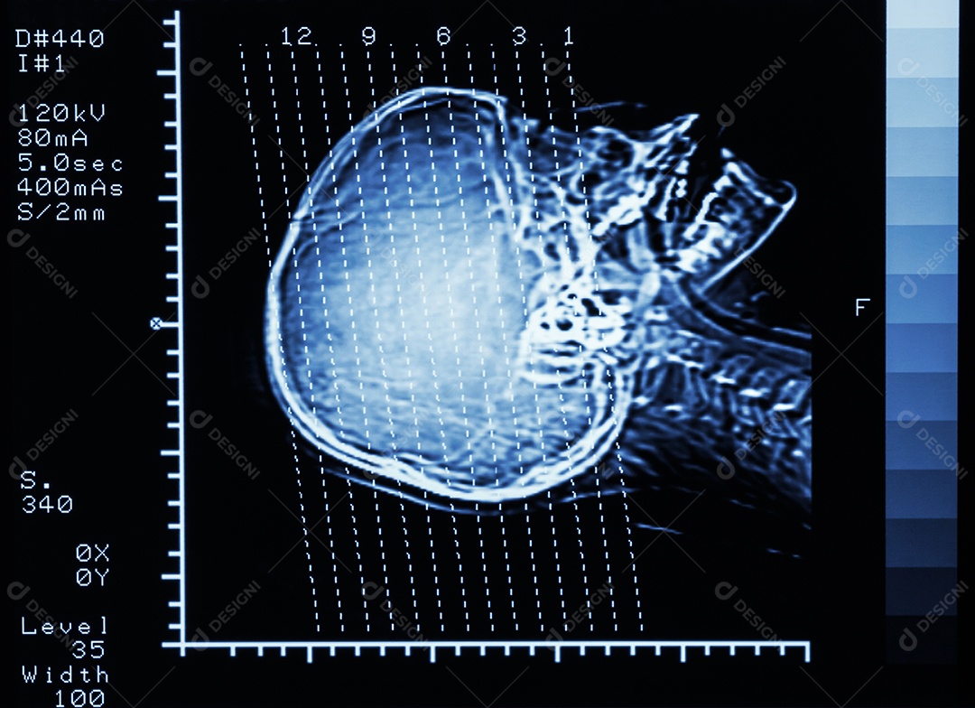 Tomografia computadorizada do cérebro mostra a linha de seção no crânio