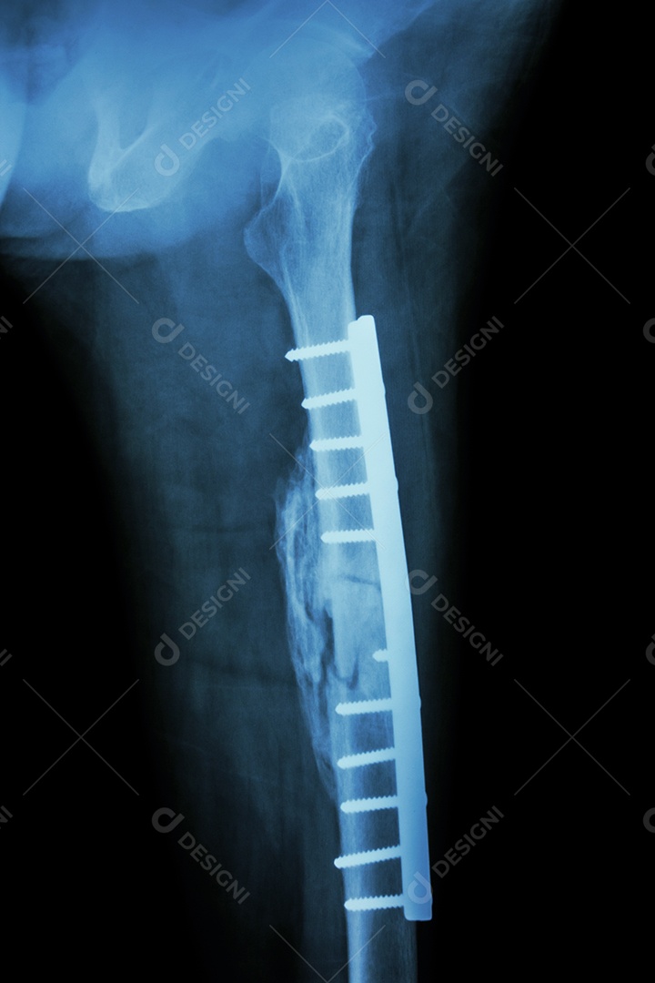 Fratura da diáfise do fêmur foi operada e fixada internamente com placa e parafuso