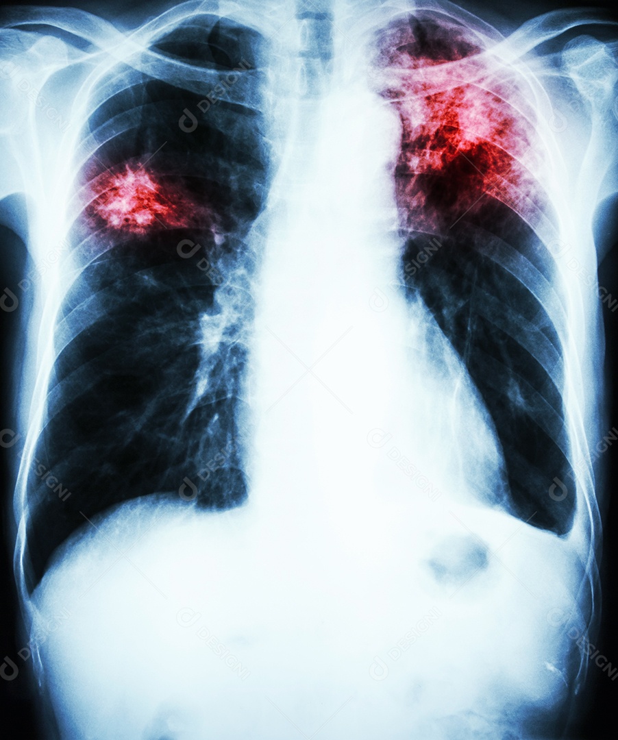 Tuberculose pulmonar raio x completo