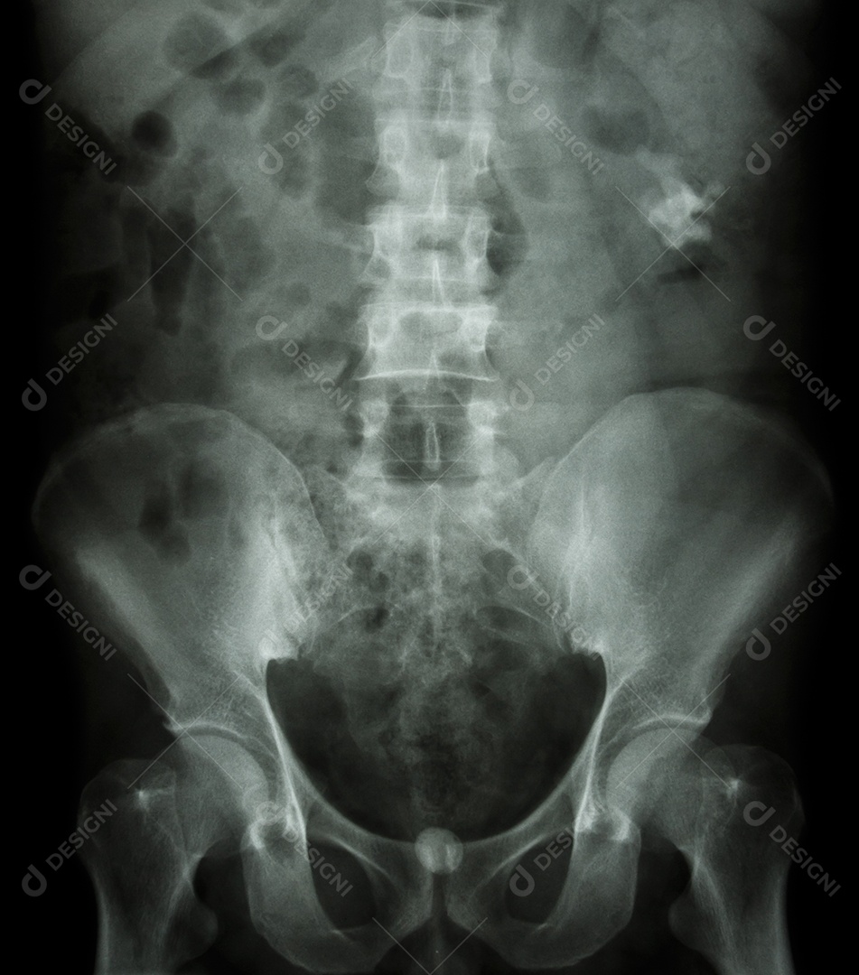 Cálculo renal esquerdo