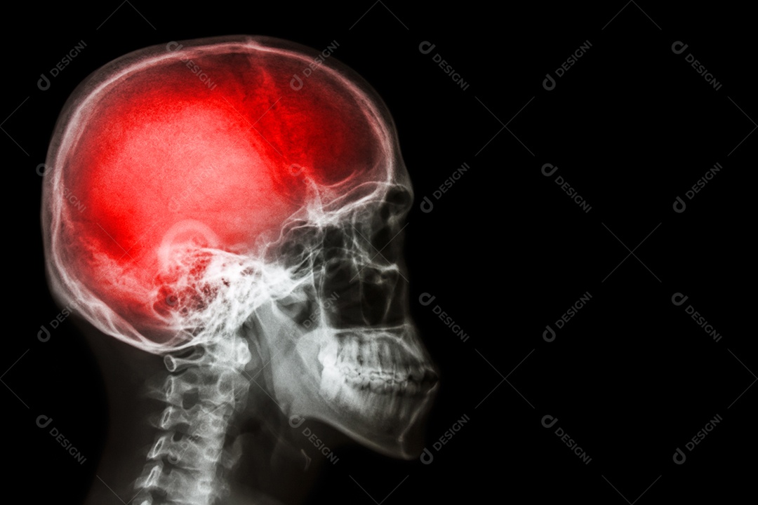 Raio X de crânio e coluna cervical lateral com AVC