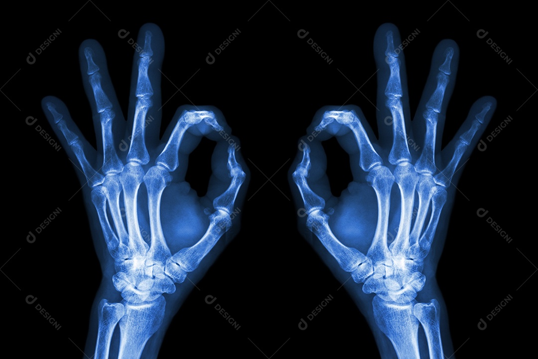 Raio x de mãos com sinal de ok