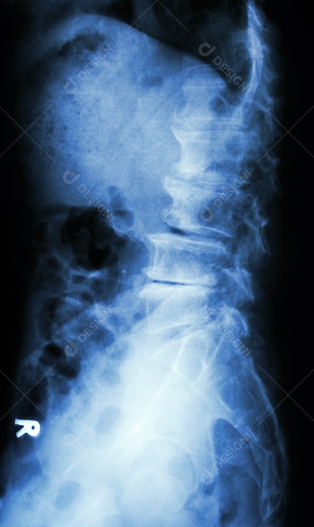 Radiografia de espondilolistese da coluna lateral