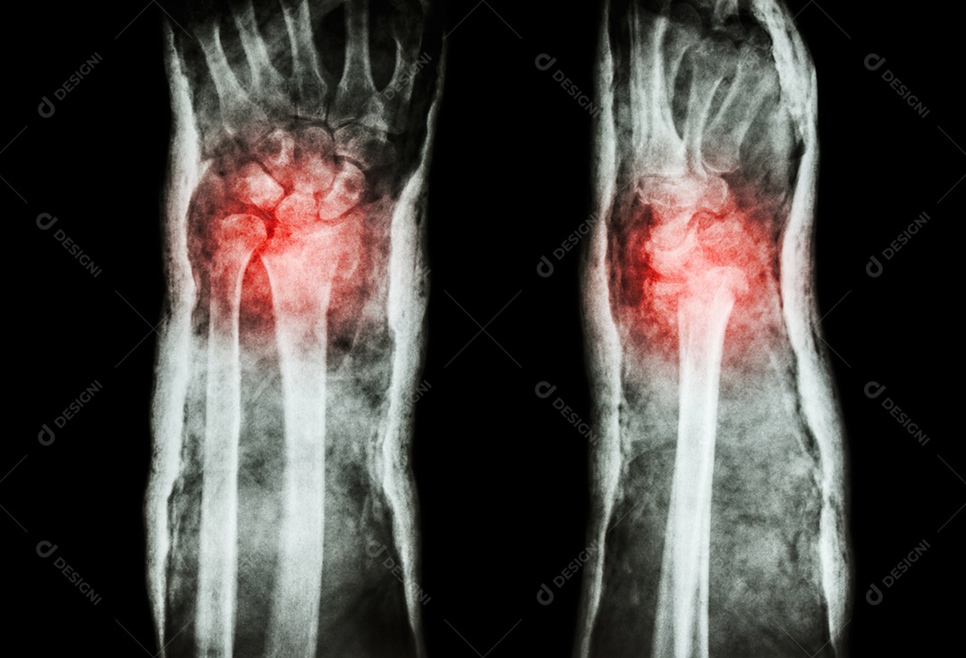 Fratura do rádio distal fratura de Colles e gesso