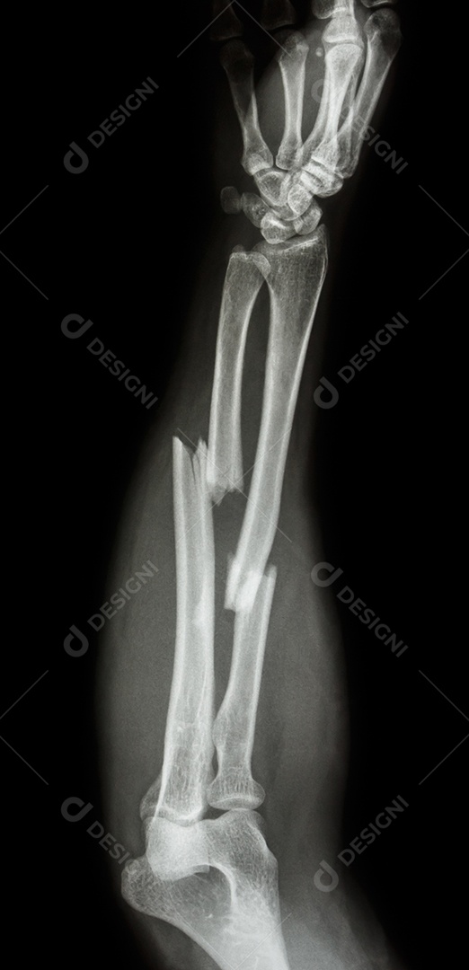Fratura do eixo do rádio e osso ulnar