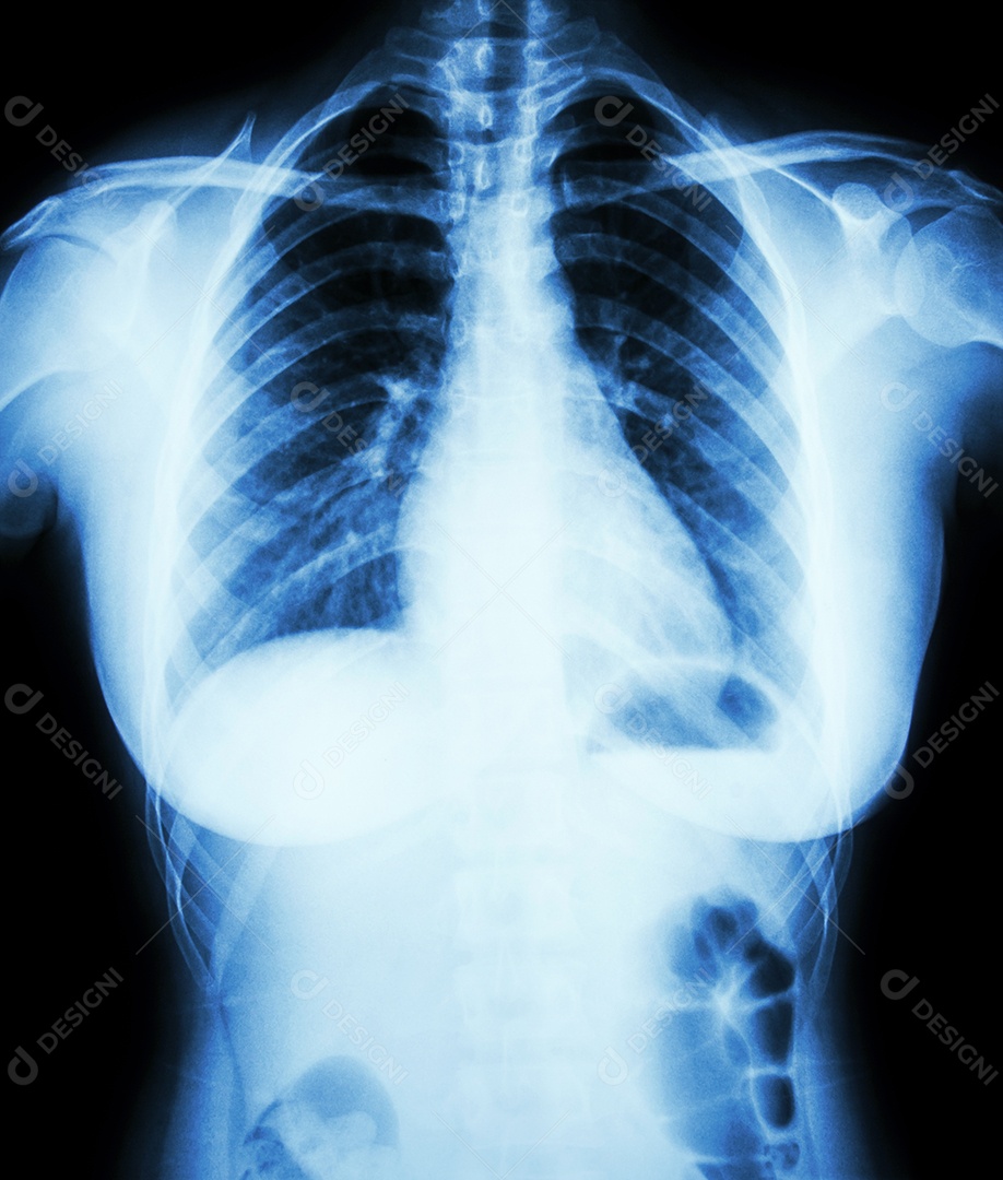 Radiografia de tórax mostra infiltrado intersticial em ambos os pulmões devido à infecção