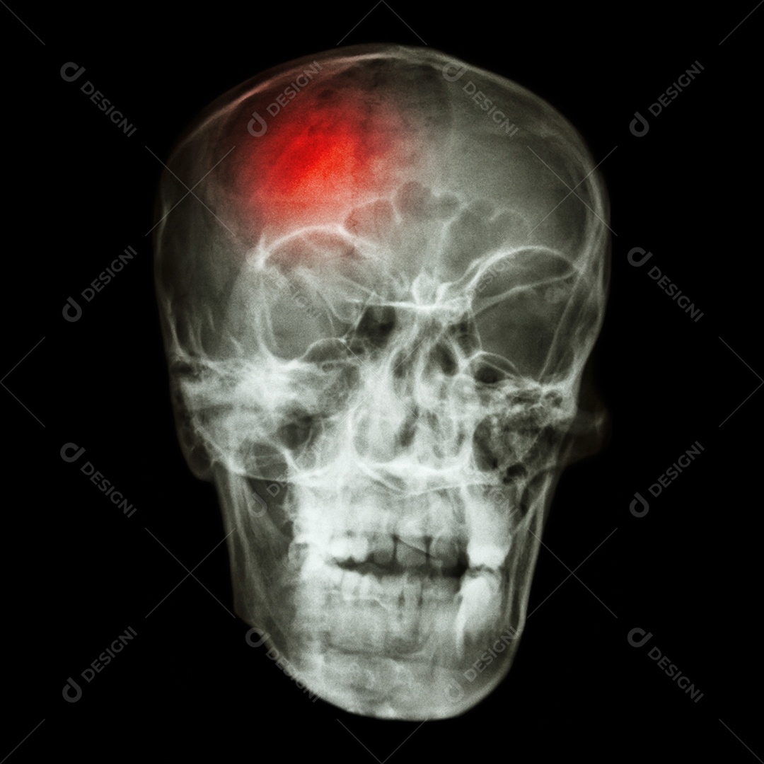 Radiografia de crânio e dor de cabeça acidente vascular cerebral