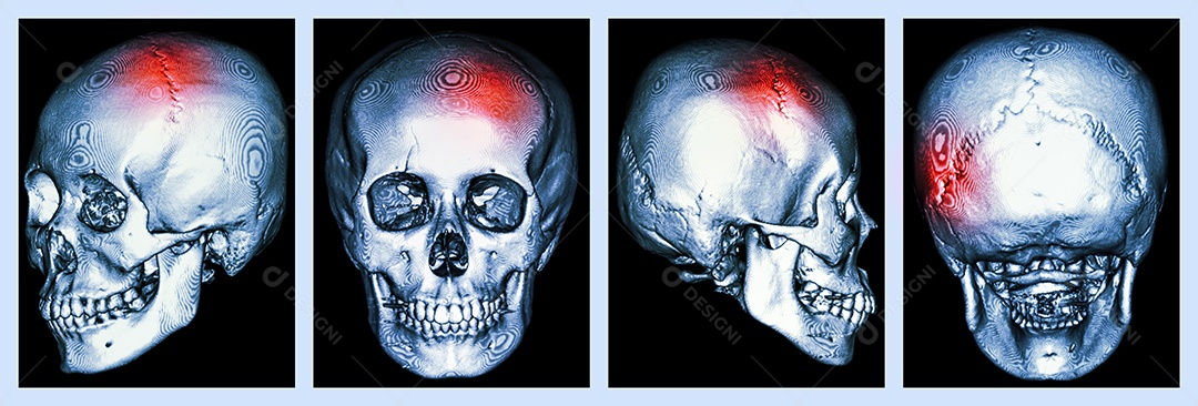 Tomografia computadorizada de crânio humano e 3D