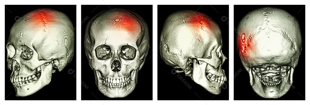 Tomografia computadorizada de crânio humano e 3D
