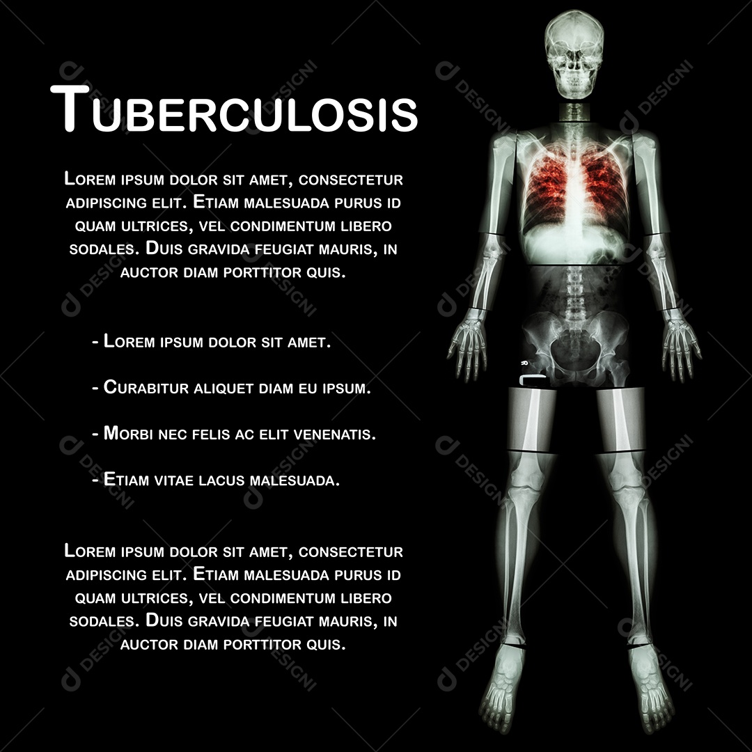 Radiografia de corpo inteiro tuberculose pulmonar tb