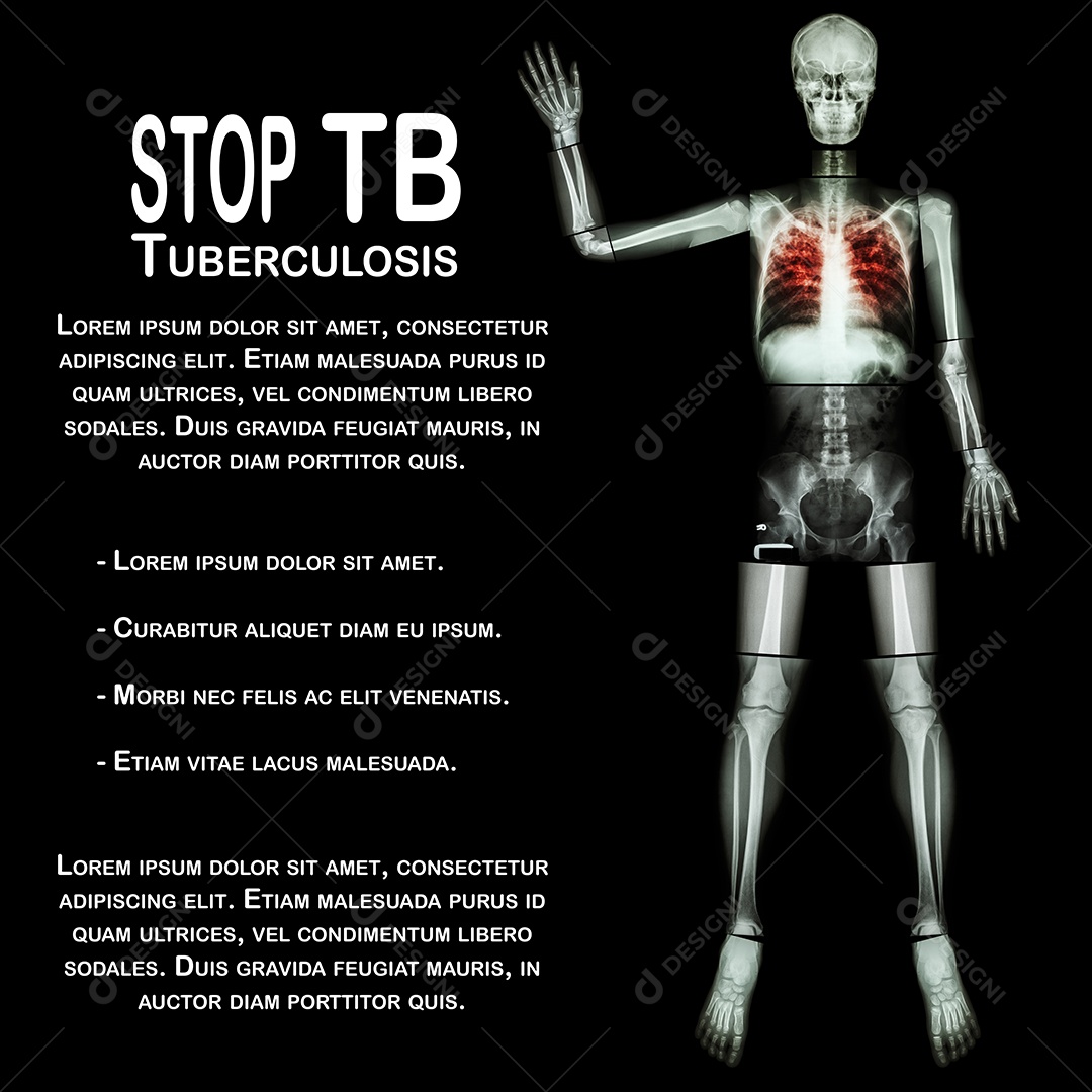 Tuberculose pulmonar mostra infiltração intersticial em ambos os pulmões devido à infecção