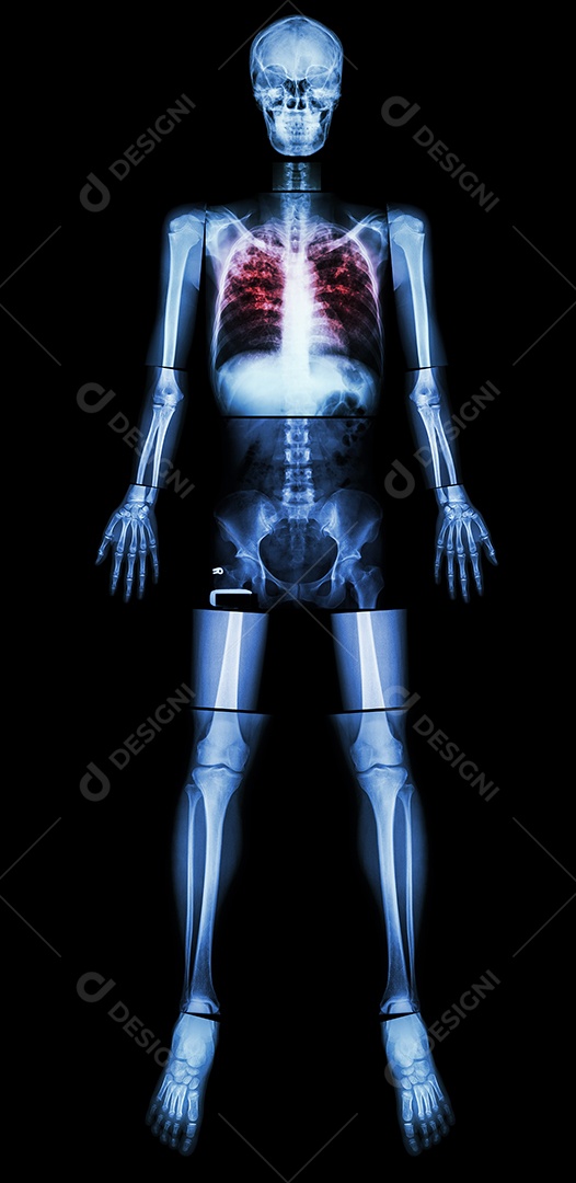 Tuberculose pulmonar raio x completo