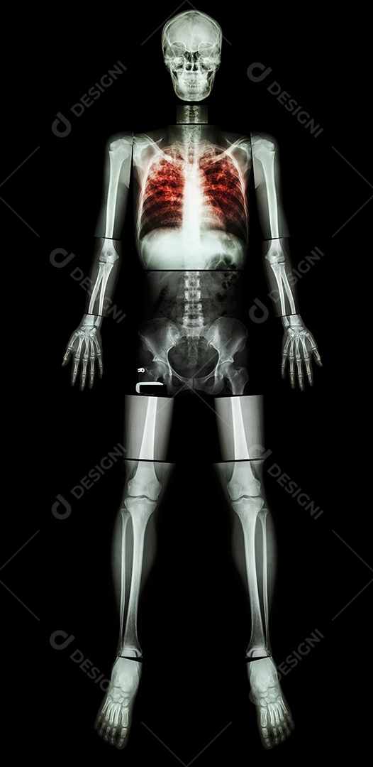 Tuberculose Pulmonar infiltração de cavidade e intersticial no pulmão