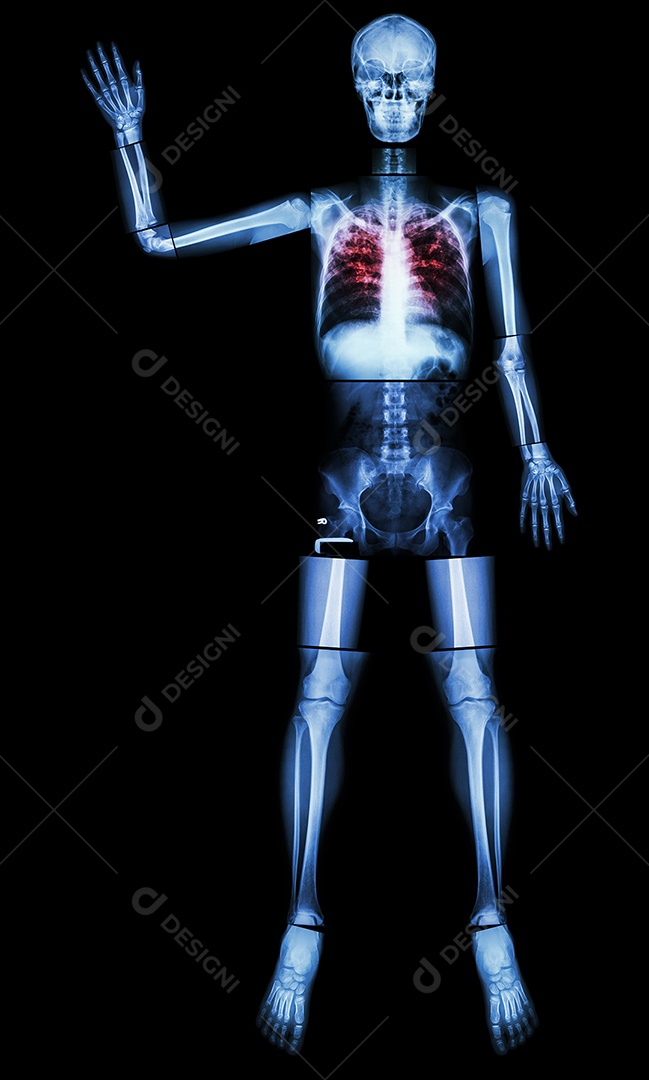 Tuberculose pulmonar com insuficiência respiratória aguda
