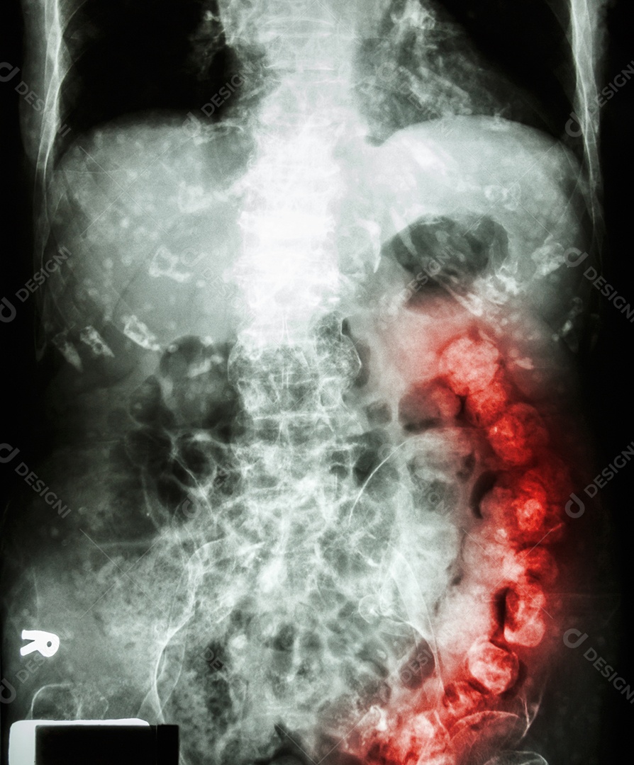 Radiografia do abdômen de um idoso muitas fezes no intestino grosso constipação