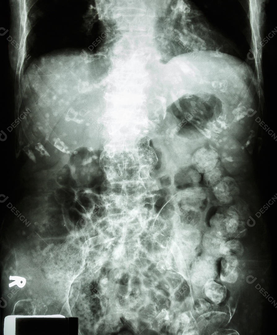 Radiografia do abdômen de um idoso muitas fezes no intestino grosso