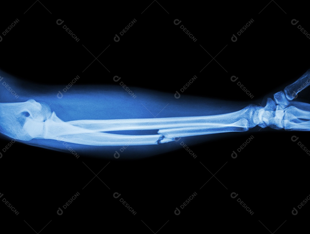 Raio X do antebraço fratura cominutiva do osso ulnar