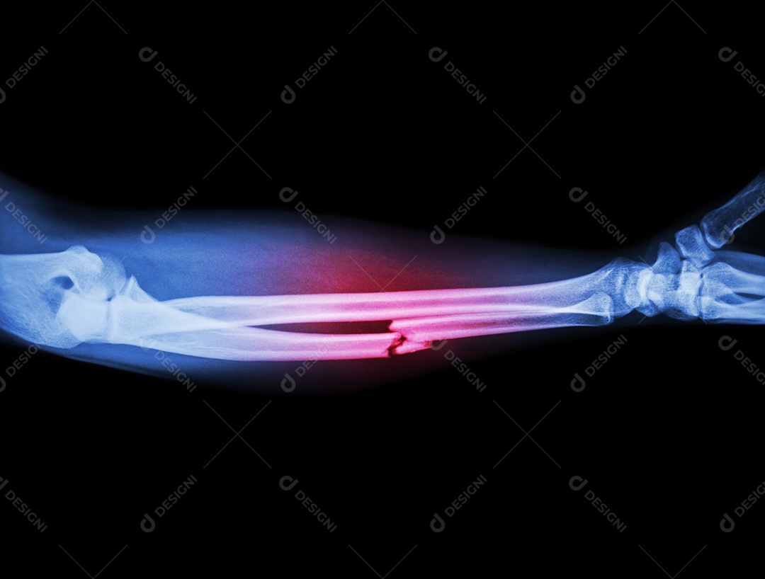 Fratura cominutiva da diáfise do osso ulnar osso do antebraço