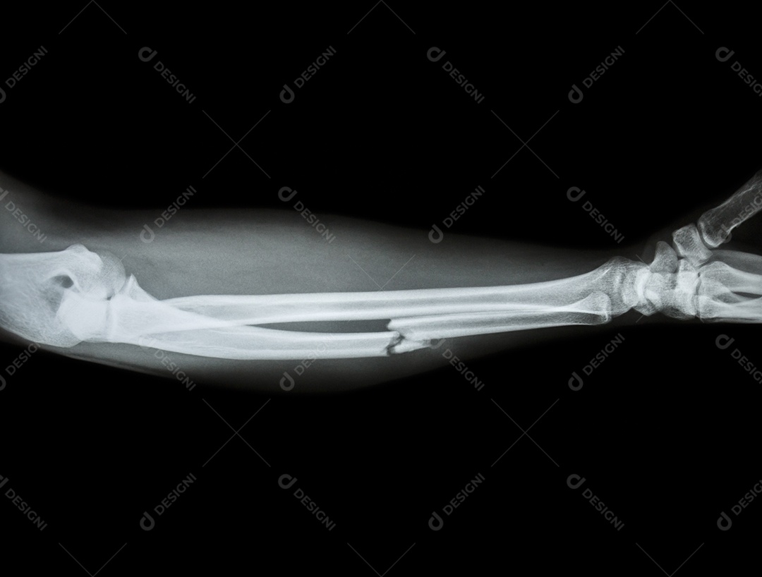 Fratura cominutiva da diáfise do osso ulnar osso do antebraço