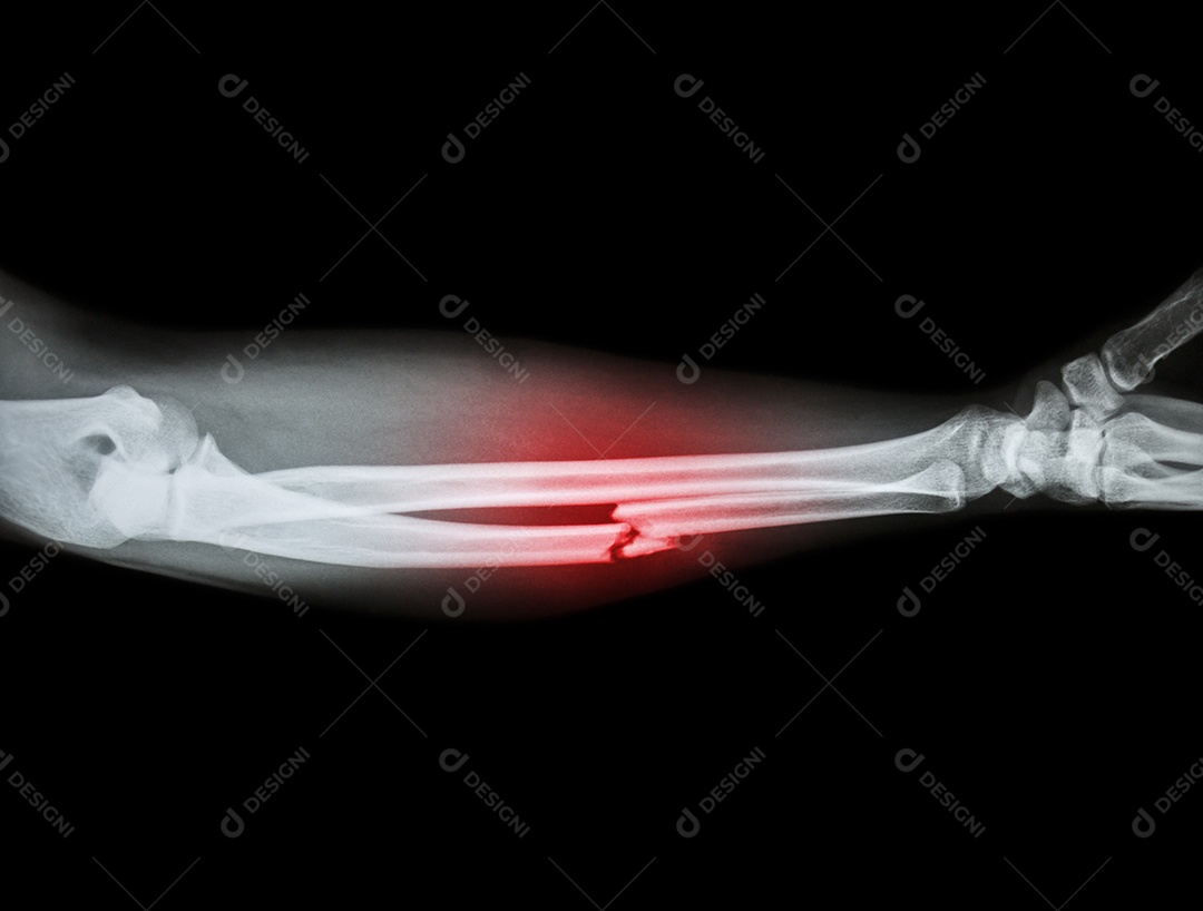 Fratura cominutiva da diáfise do osso ulnar osso do antebraço