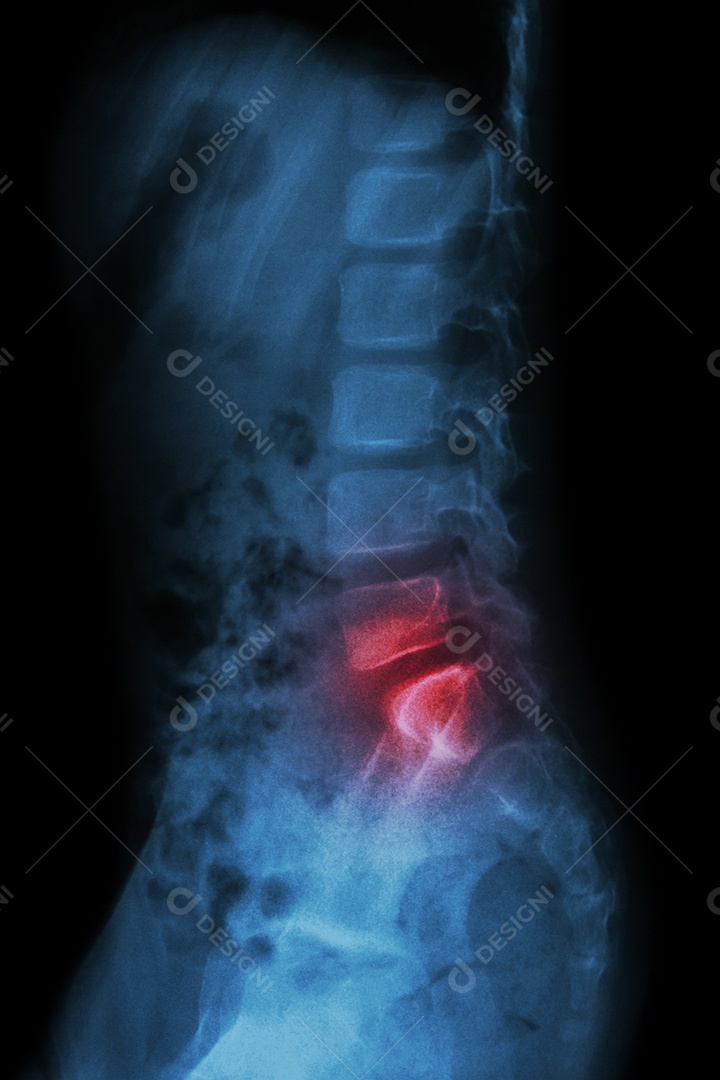 Coluna lombar da criança radiografia torácica