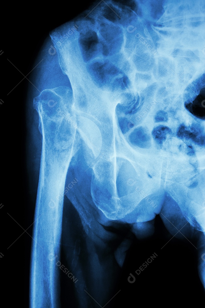 Raio x da pelve e articulação do quadril fratura da cabeça do fêmur