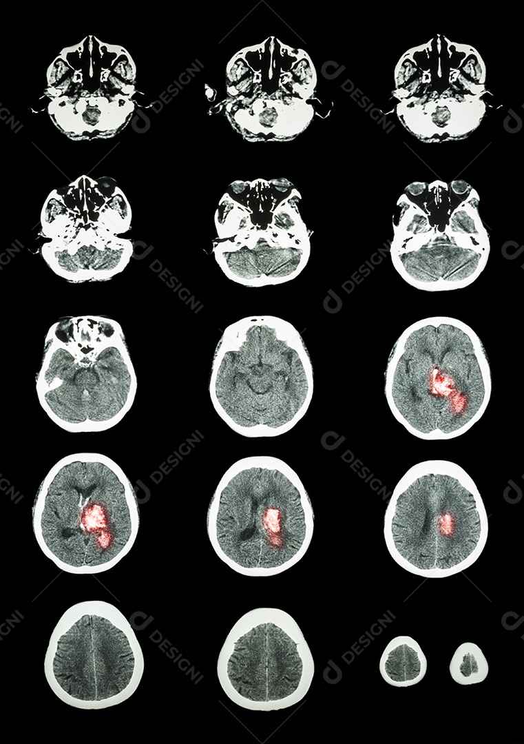 Tomografia computadorizada de crânio humano e 3D