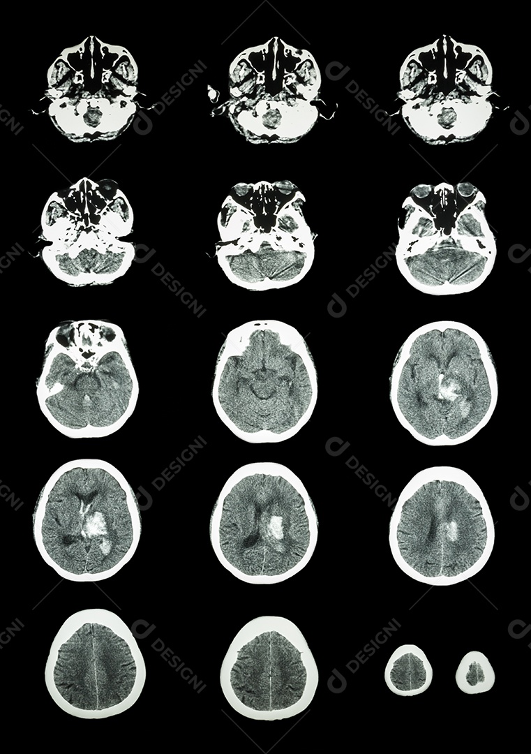 Tomografia computadorizada de crânio humano e 3D