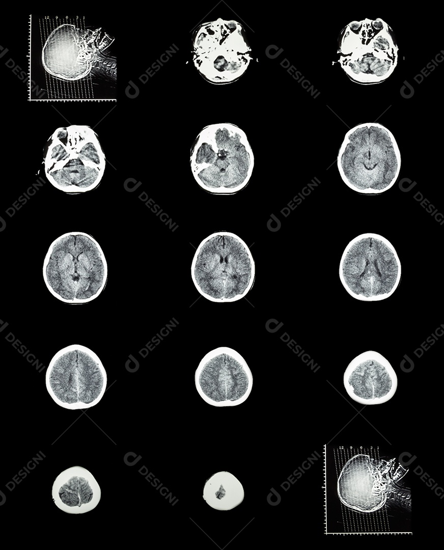 Tomografia computadorizada do cérebro normal sistema cerebrovascular