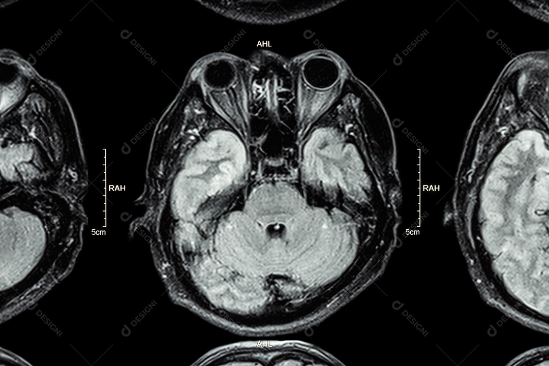 Cérebro de ressonância magnética parte inferior do cérebro