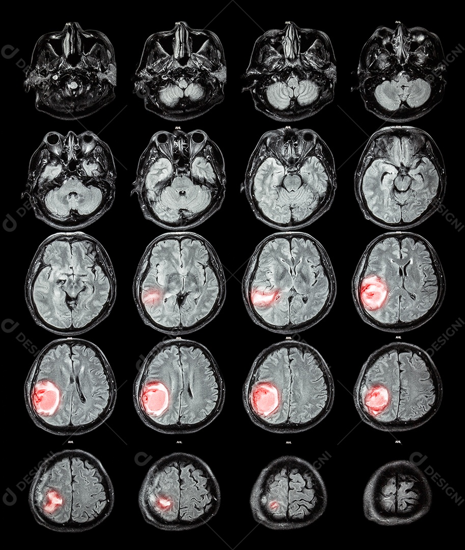 Cérebro de ressonância magnética parte inferior do cérebro