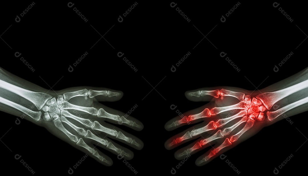 Apertar as mãos em raio x