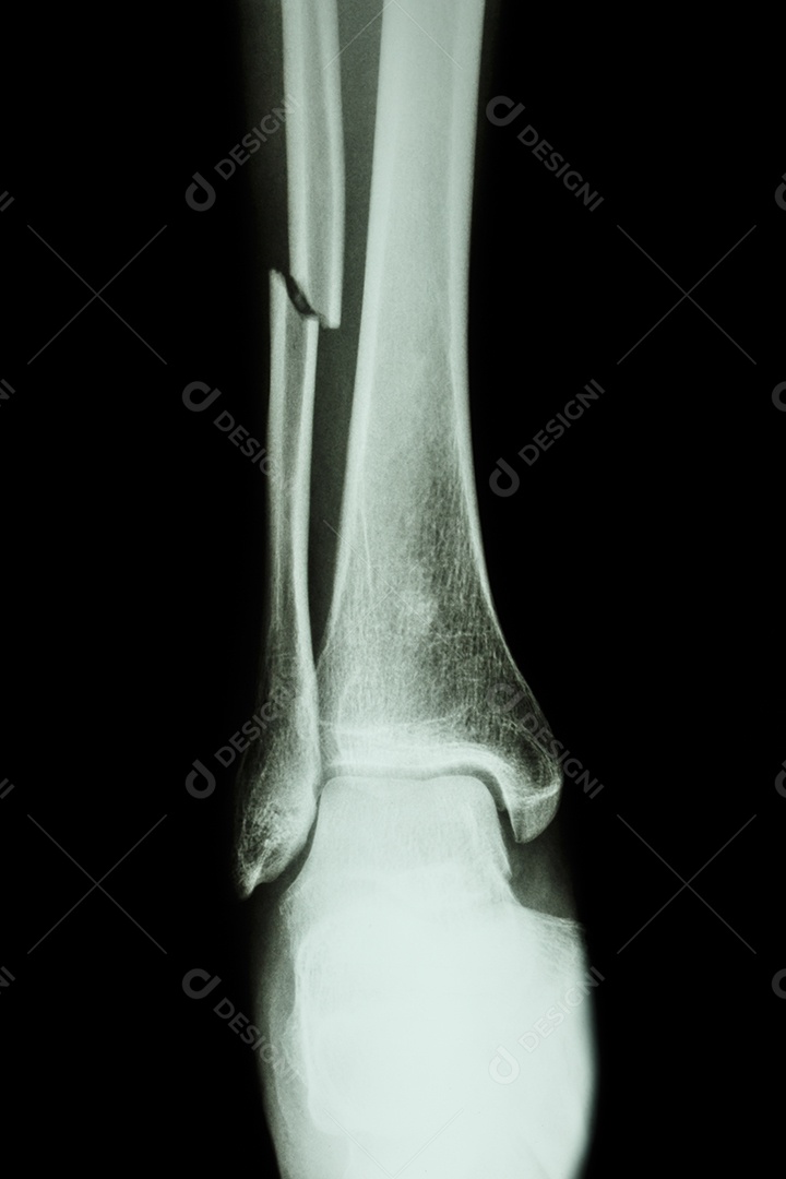 Fratura no corpo humano mostrado em raio x