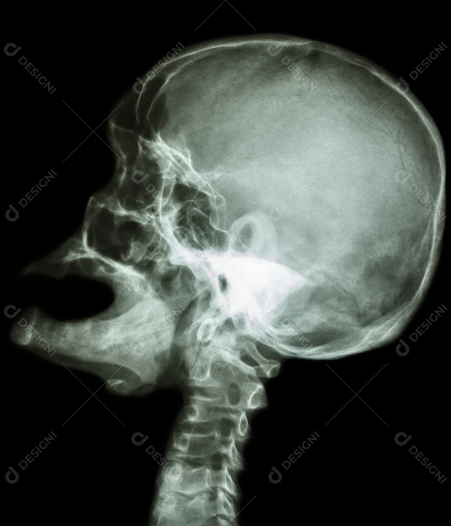 Raio X do crânio boca aberta e olhar para cima e acidente vascular cerebral