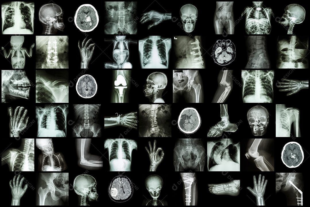 Radiografia de múltiplas partes de adultos e crianças e doenças