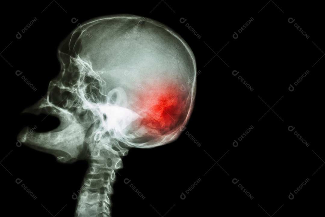 Raio X de crânio com boca aberta