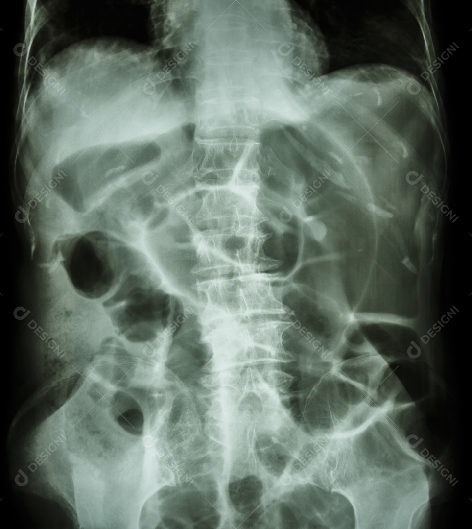 Obstrução intestinal raio x do abdômen em decúbito dorsal